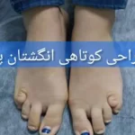 جراحی کوتاهی انگشتان پا