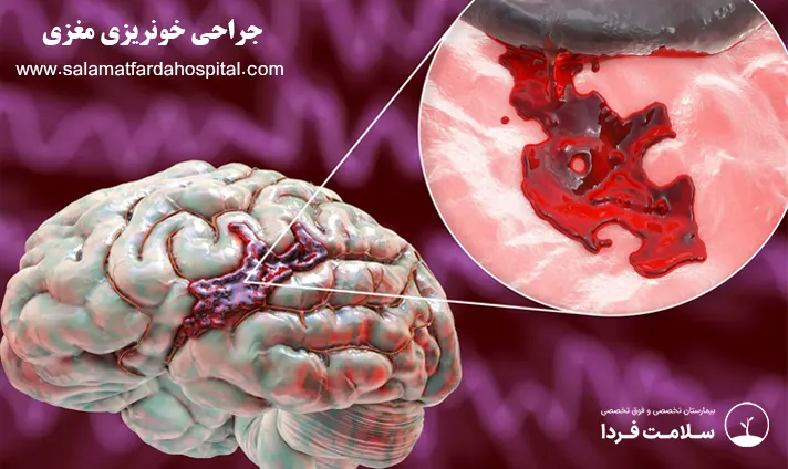 جراحی خونریزی مغزی