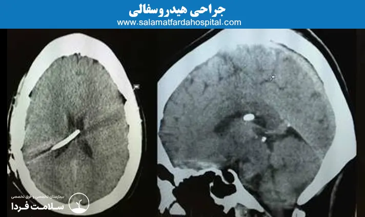 جراحی هیدروسفالی