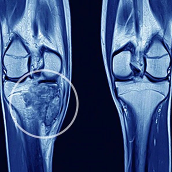 Malignant Bone Tumor (with device)