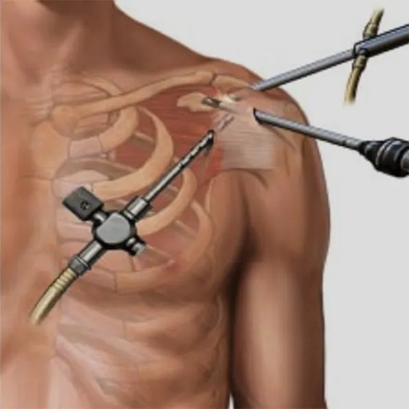 Shoulder Arthroscopy