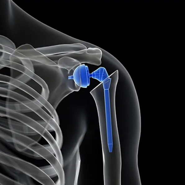 Shoulder replacement (with device)
