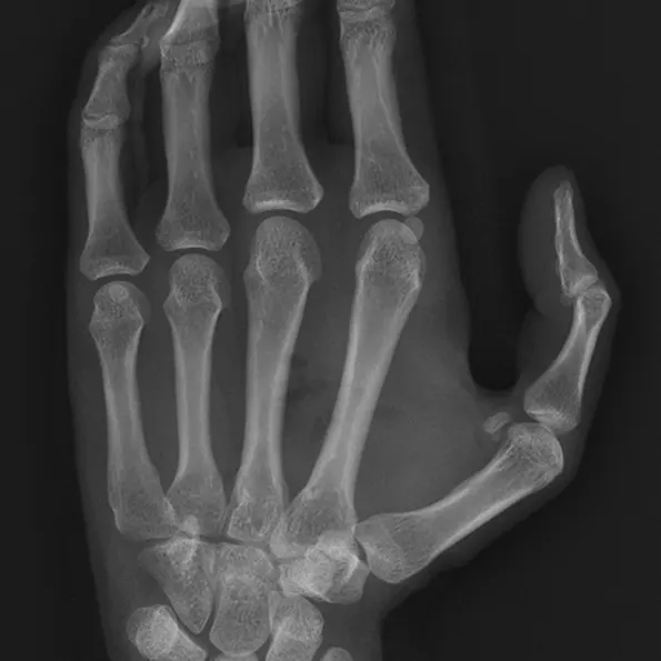 Soft Tissue Tumor (with device)