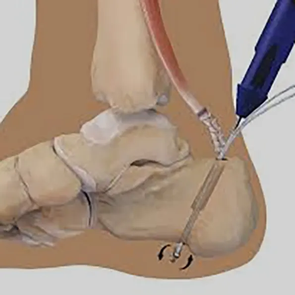 Tendon Transfer (with device)