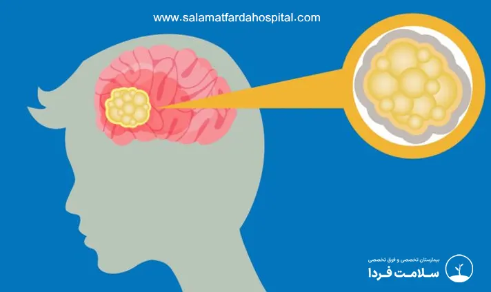 علل مننژیوم مغزی