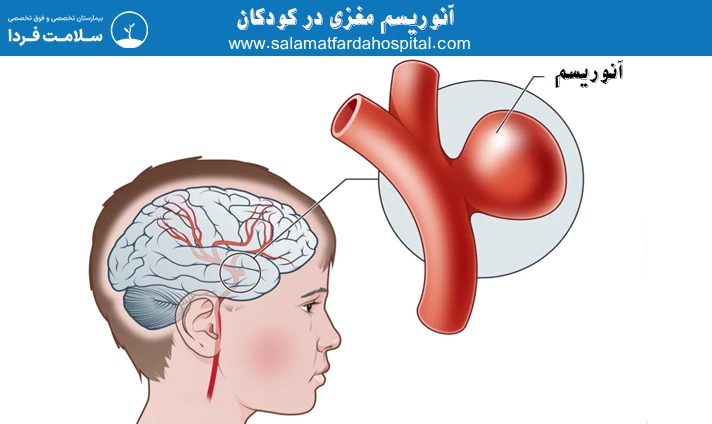 آنوریسم مغزی در کودکان