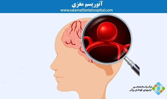 آنوریسم مغزی
