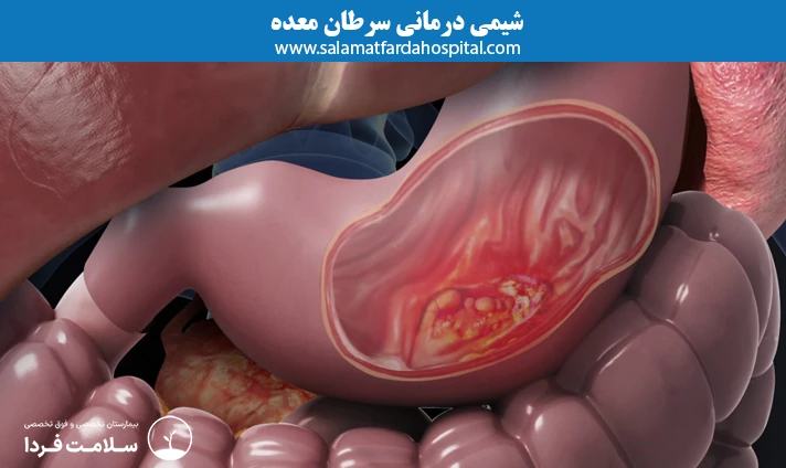شیمی درمانی سرطان معده