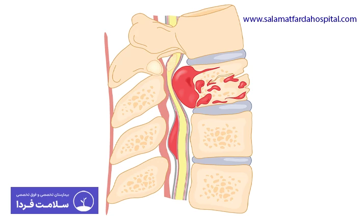 علائم تومور نخاعی