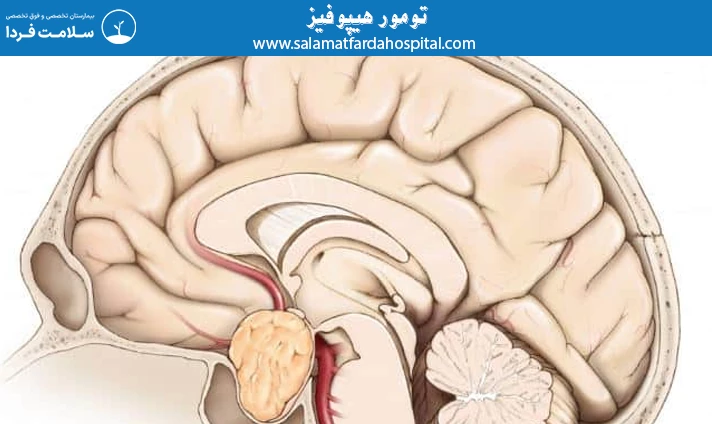 تومور هیپوفیز