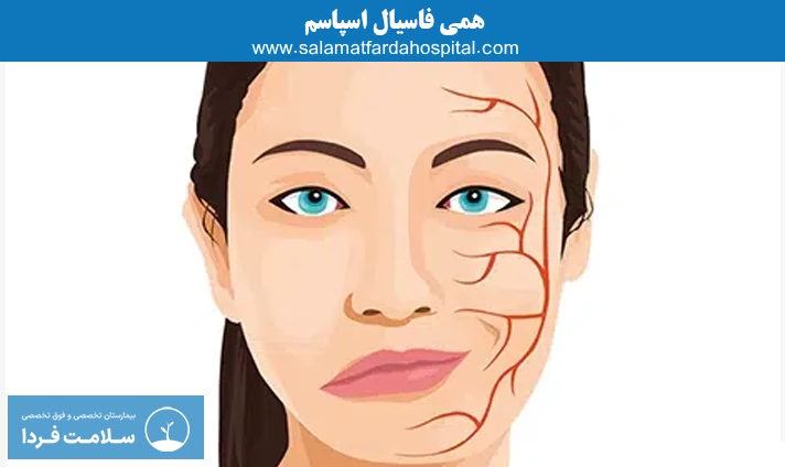 همی فاسیال اسپاسم