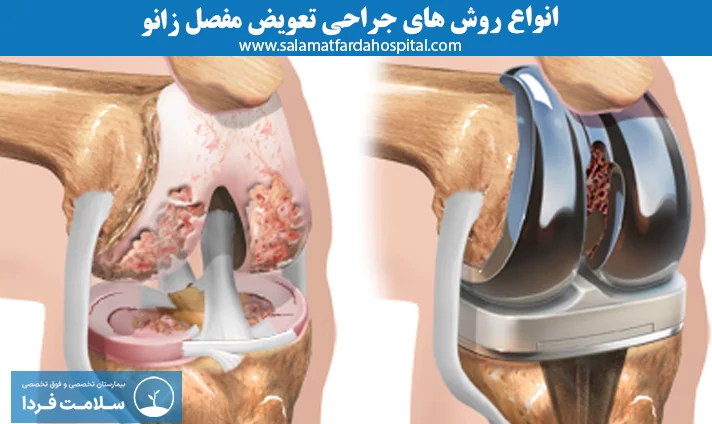 انواع روش‌های جراحی تعویض مفصل زانو