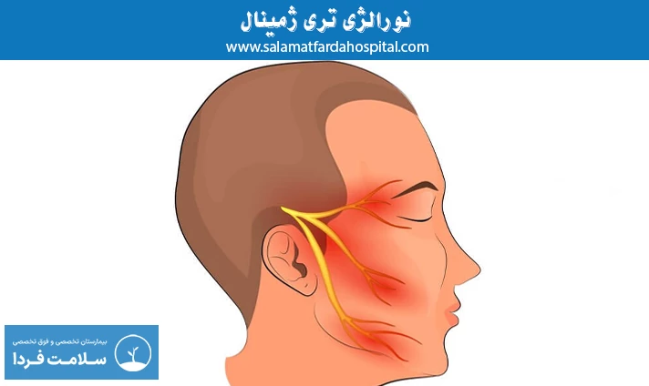 نورالژی تری ‌ژمینال
