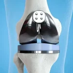 راهکارهای افزایش طول عمر مفصل مصنوعی زانو