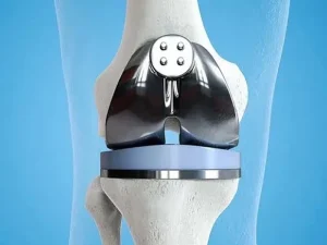 راهکارهای افزایش طول عمر مفصل مصنوعی زانو