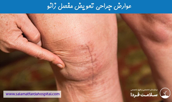 عوارض جراحی تعویض مفصل زانو