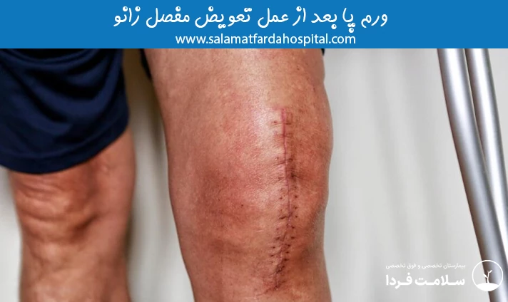 ورم پا بعد از عمل تعویض مفصل زانو