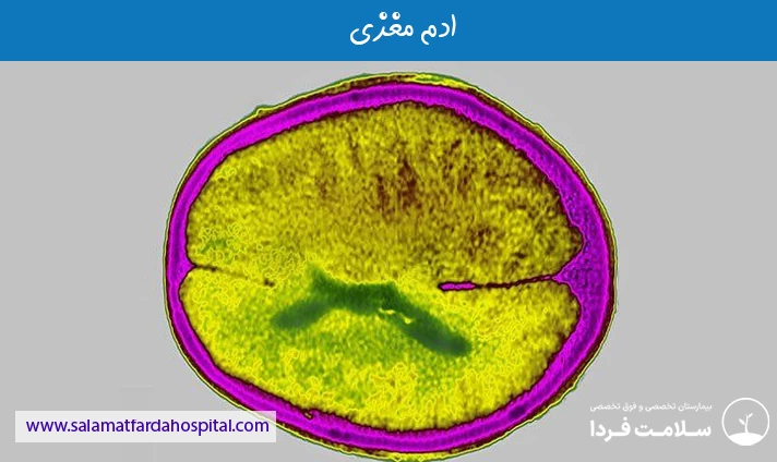 ادم مغزی