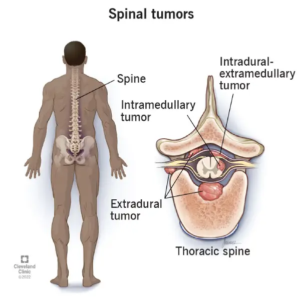 Extramedullary Spinal cord Tumor