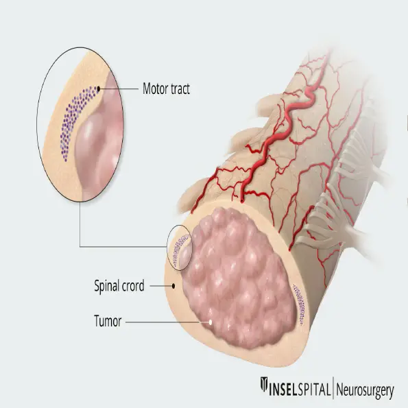 Intramedullary spinal cord tumor