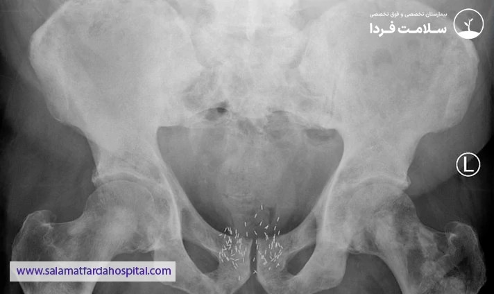انواع روش های درمان با براکی تراپی
