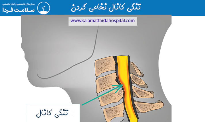 تنگی کانال نخاعی گردن