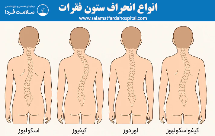 انواع انحراف ستون فقرات