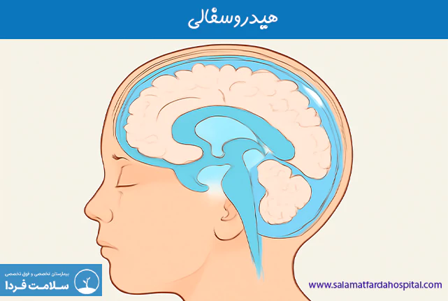 هیدروسفالی